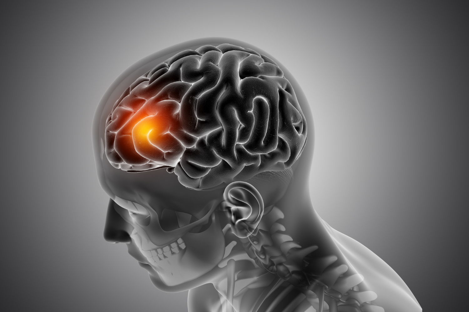 Brain Metastasis Treatment